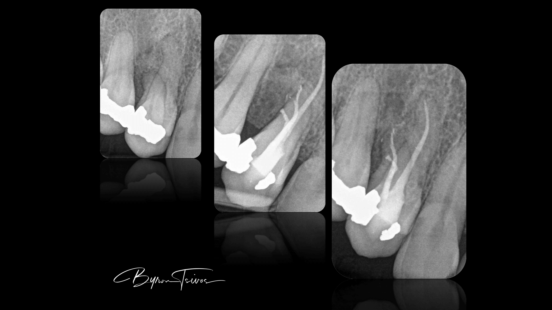 Blocked Canals - Case 3